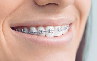boy wearing metal braces with nice smile