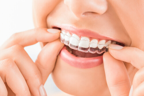 young woman using Invisalign clear aligner to straighten teeth