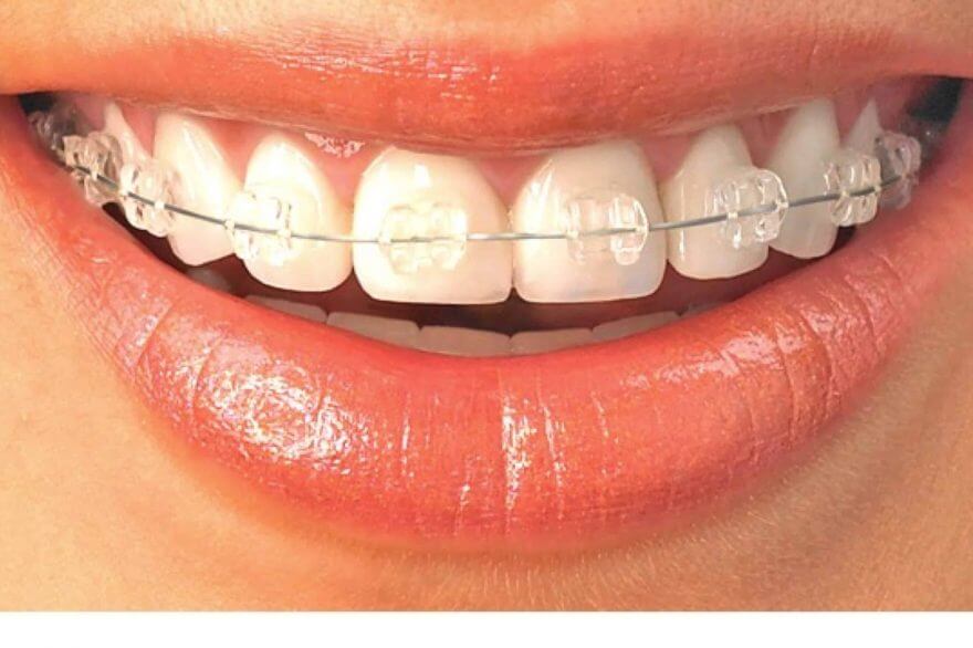 Clear braces for orthodontic treatment