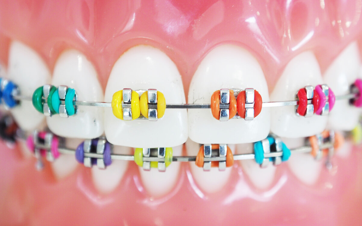 Colored Braces for orthodontic treatment in Cornelius, NC
