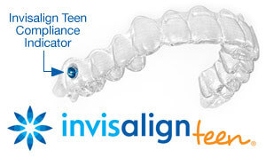 Invisalign teen clear aligner with compliance indicator